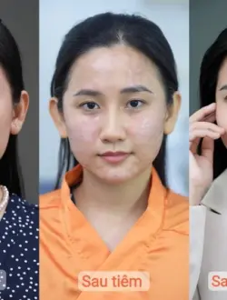 Tiêm Meso Uy Tín: Giải Pháp Làm Đẹp Hiệu Quả Tại Elite Aesthetic Quận 3