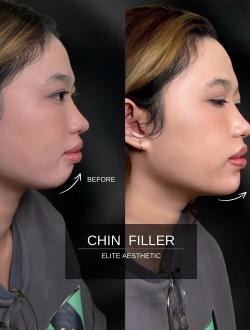 Filler Cằm 
