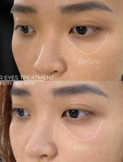 Tiêm Xóa Quầng Thâm Mắt: Giải Pháp Làm Sáng Vùng Mắt Hiệu Quả Tại Elite Aesthetic Quận 3