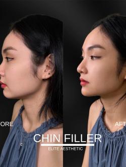 Tiêm Botox Uy Tín Tại Quận 3 Tại Elite Aesthetic