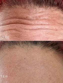 Botox Xoá Nhăn Trán