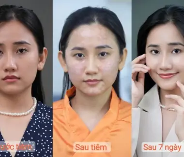 Tiêm Meso Uy Tín: Giải Pháp Làm Đẹp Hiệu Quả Tại Elite Aesthetic Quận 3