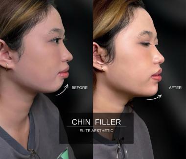 Filler Cằm 