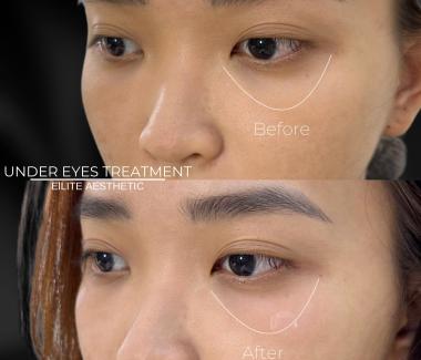 Tiêm Xóa Quầng Thâm Mắt: Giải Pháp Làm Sáng Vùng Mắt Hiệu Quả Tại Elite Aesthetic Quận 3
