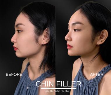 Tiêm Botox Uy Tín Tại Quận 3 Tại Elite Aesthetic