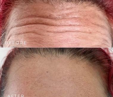Botox Xoá Nhăn Trán